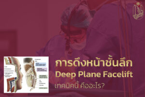 Deep Plane Facelift คืออะไร?